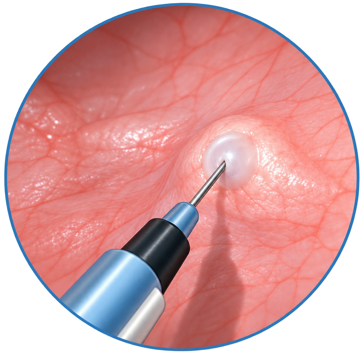 Vue rapprochée du point d’injection à l’intérieur de la vessie.