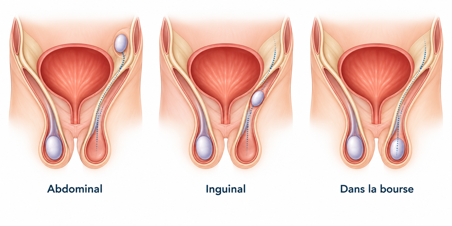 Trois positions du testicule : abdominale, inguinale et dans la bourse.