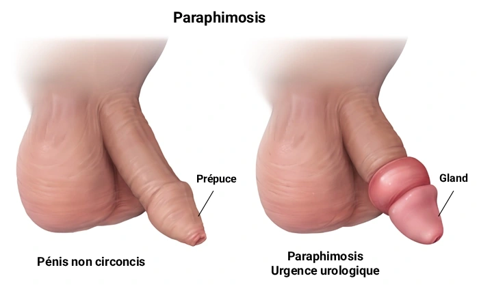 À gauche, un pénis non circoncis avec son prépuce en position normale. À droite, un paraphimosis : le prépuce est bloqué derrière le gland.